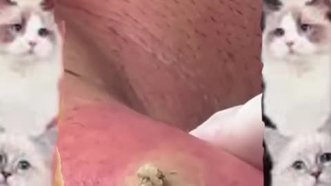 Skin cleansing & Pedicure AZ #fyp#foryou#fyp #pimple #satisfyingvideo #viralvedio