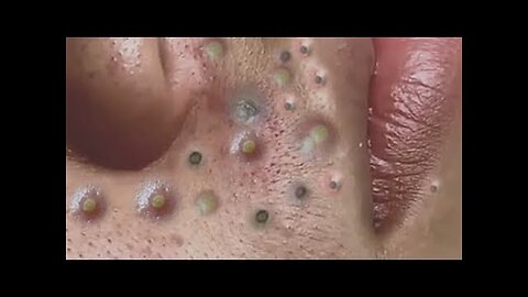 Blackhead removal and pimple Popper