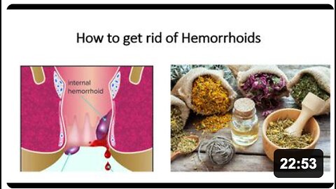 Hemorrhoids & Piles - Nautrual Treatment Options