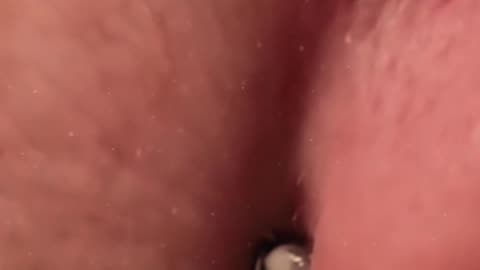 Blackheads on the nose extraction (ASMR) #2 #shorts