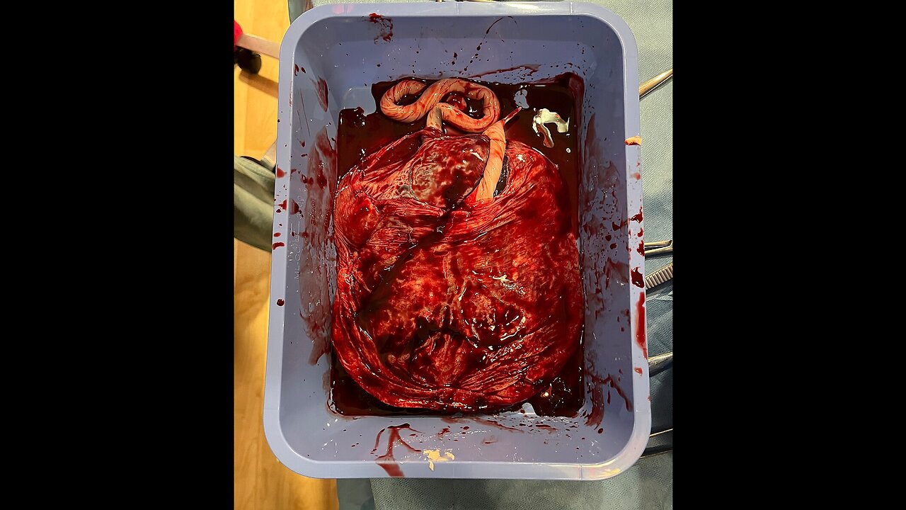 TREATING DEPRESSION SYMPTOMS OF DEMONIC INFESTATION THROUGH CANNIBALISM