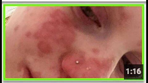 "22-Year-Old Woman Severely Scarred by Stevens-Johnson Syndrome Caused by Vaxx Poison"