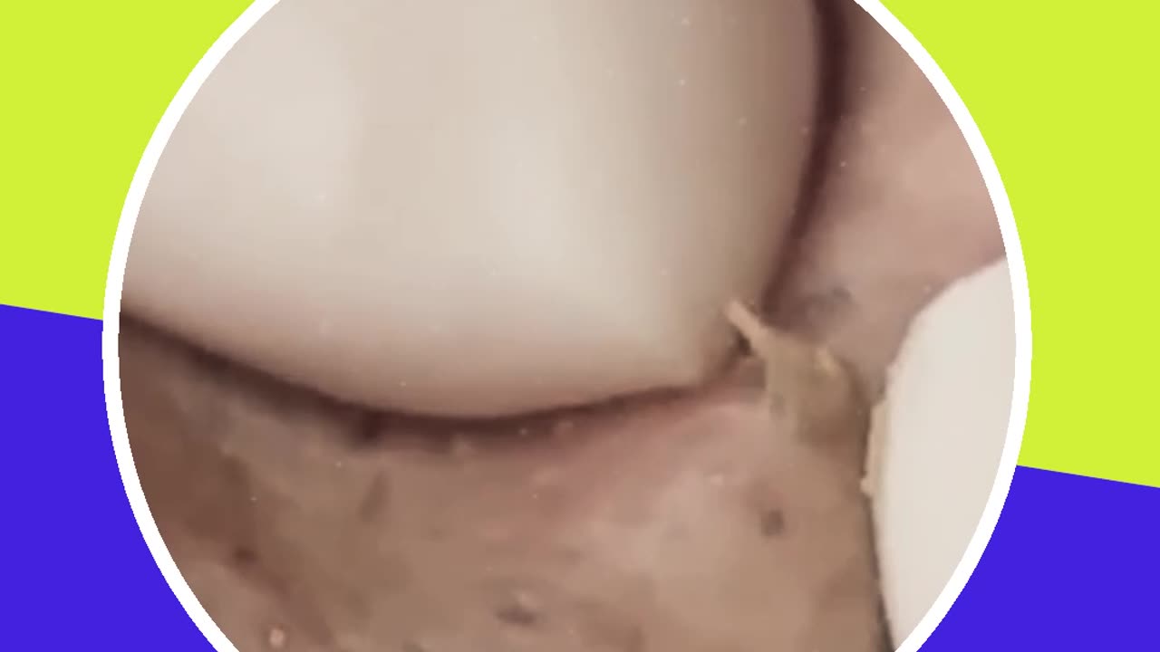 Blackhead removal new this week (ASMR) #19 #shorts