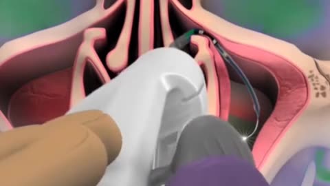 Balloon Sinuplasty Procedure 3D Animation