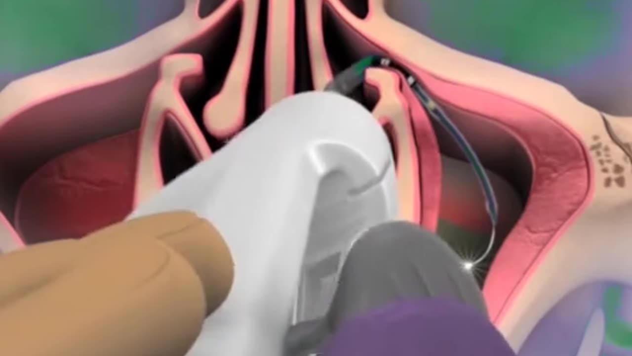 Balloon Sinuplasty Procedure 3D Animation