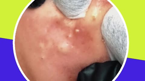 Pimple removal satisfying video (ASMR) #20 #shorts
