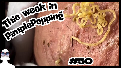 This Week In PIMPLE POPPING #51