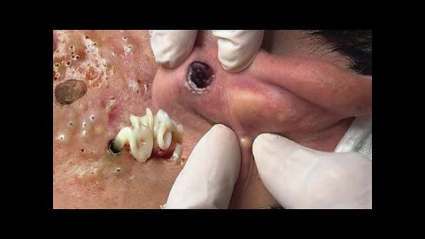 Achieve Inner Peace With Black and whiteheads removal