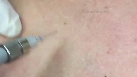 Treating angiomas DPNs on the chest with electrocautery For medical education NSFE