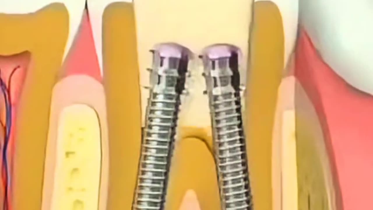Root Canal Procedure Explained 🦷 Save Your Tooth Painlessly!
