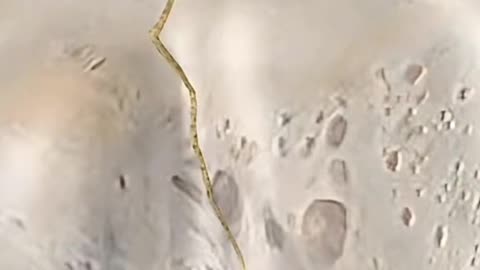 Humerus Plating Surgery – Fixing Broken Arm Bone Step by Step