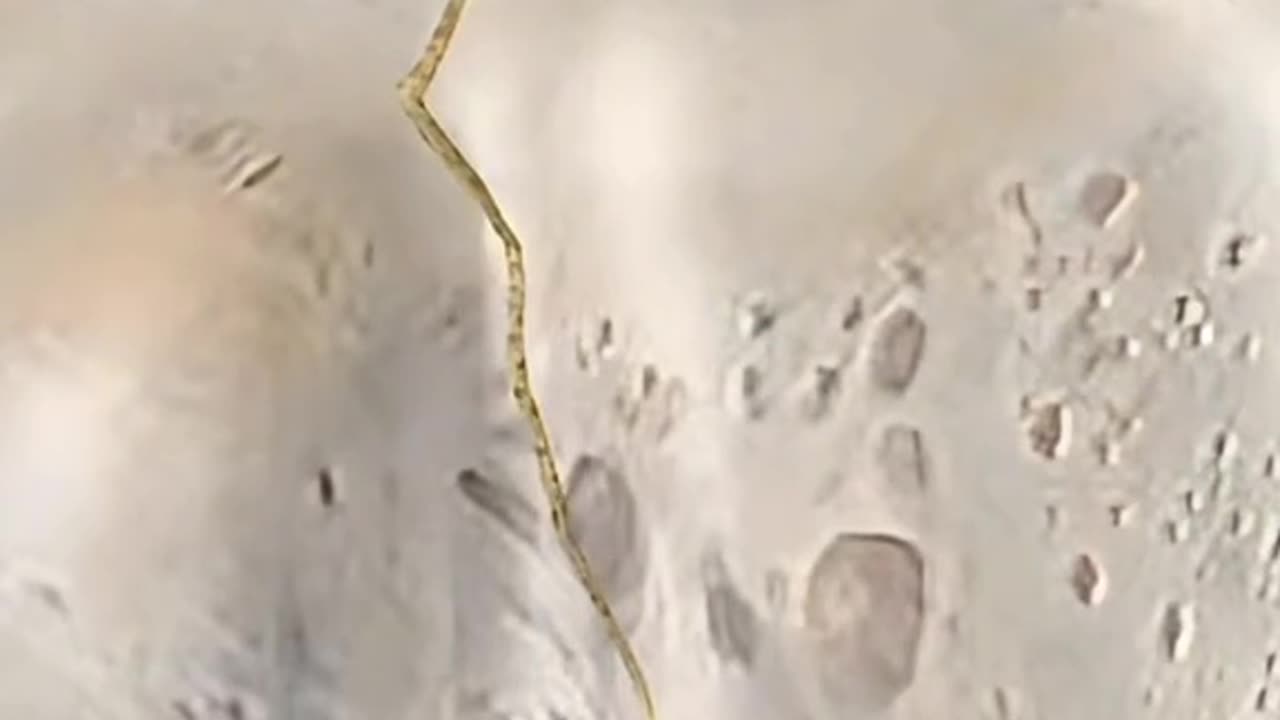 Humerus Plating Surgery – Fixing Broken Arm Bone Step by Step