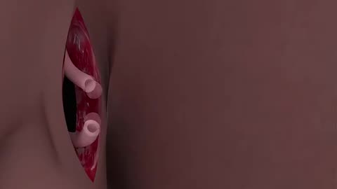 Vasectomy Reversal Surgery (3D Animation)