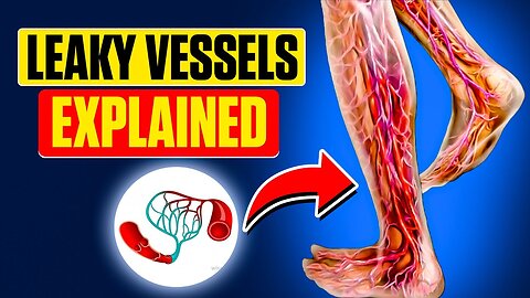 Capillary Leak Syndrome Explained Causes, Symptoms & Treatment Earthluxe