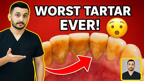 Removing tartar and cleaning the gums