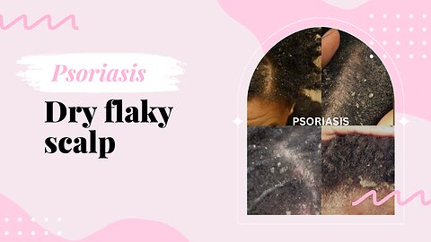 Scratching dry flaky scalp #dandruff #psoriasis #fyp