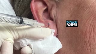 A nice earlobe blackhead extracted
