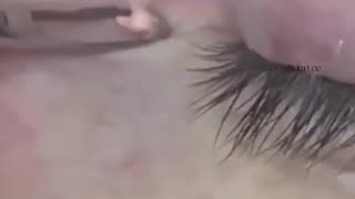 ️ It s So Small But It Hurts Dr Pimple Popper vs Eye