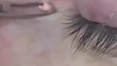 ️ It s So Small But It Hurts Dr Pimple Popper vs Eye