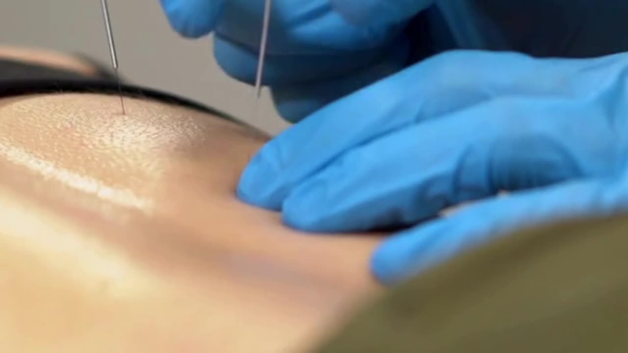 IMS / Dry Needling Therapy | Golden Maple Physiotherapy Maple Ridge