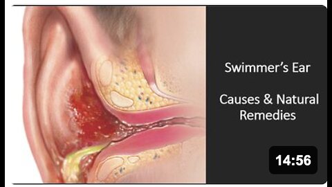 Swimmers Ear - Natural Treatment