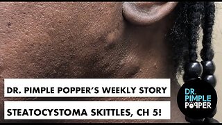Dr Pimple Popper s Weekly StoryTime Steatocystoma Skittles Chapter 5