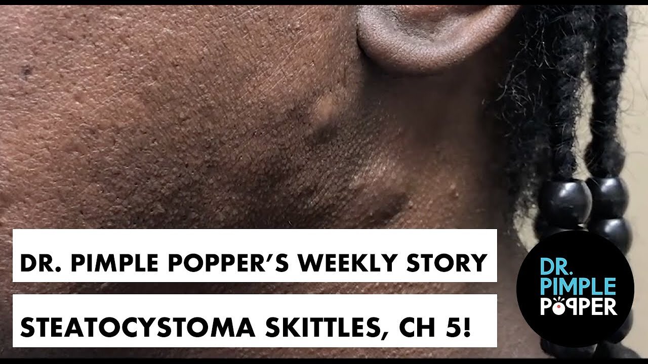 Dr Pimple Popper s Weekly StoryTime Steatocystoma Skittles Chapter 5