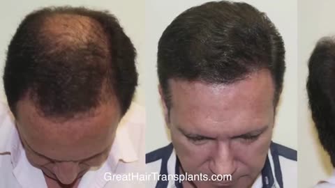MaxHarvest™ Hair Transplant Results Compilation by Dr. Brett Bolton (Part 1)