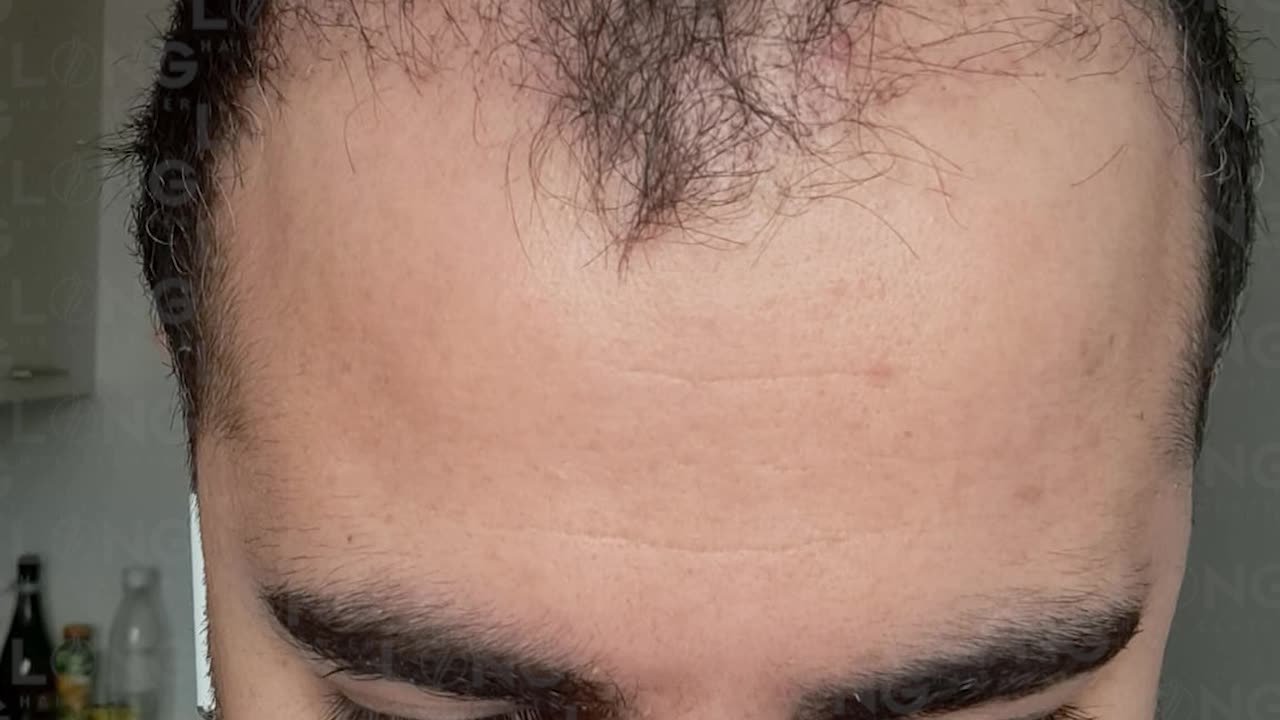 Long Hair Centre has the solution to your baldness, do not hesitate to take advantage of it.