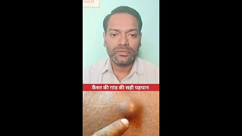 कैंसर की गांठ की सही पहचान ।