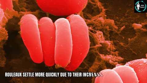 MD09-Erythrocyte Sedimentation Rate (ESR) Test What You Need To Know