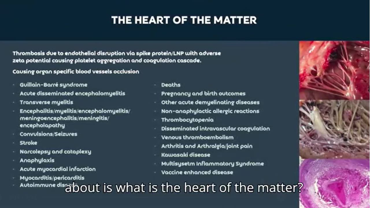 UK Cardiologist Explains Blood Vessel Damage of mRnA Injections