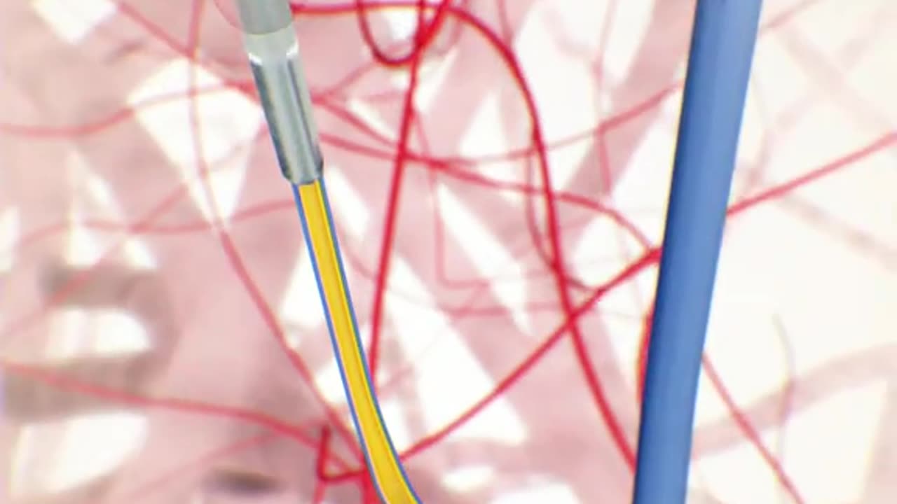 Treating Varicose Veins With Laser! (3D Animation)