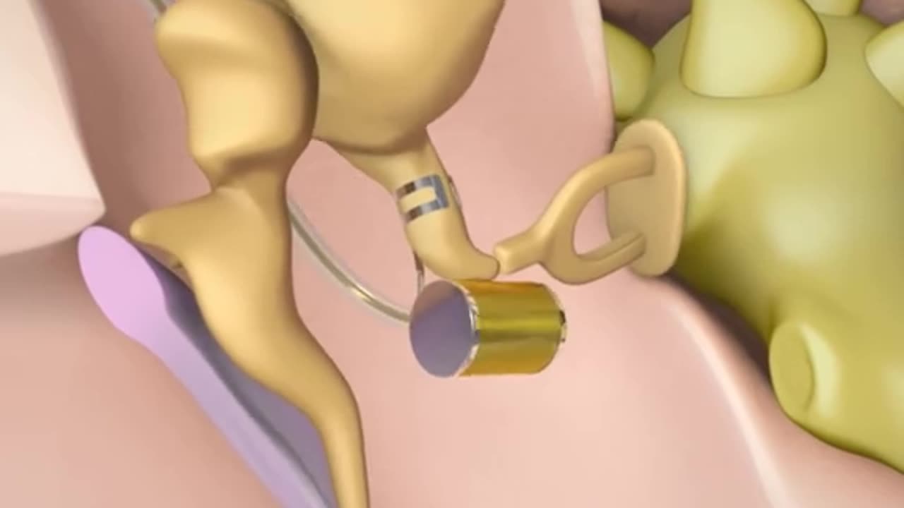 How Sound Bridge Hearing Aid Device Works (3D Animation)