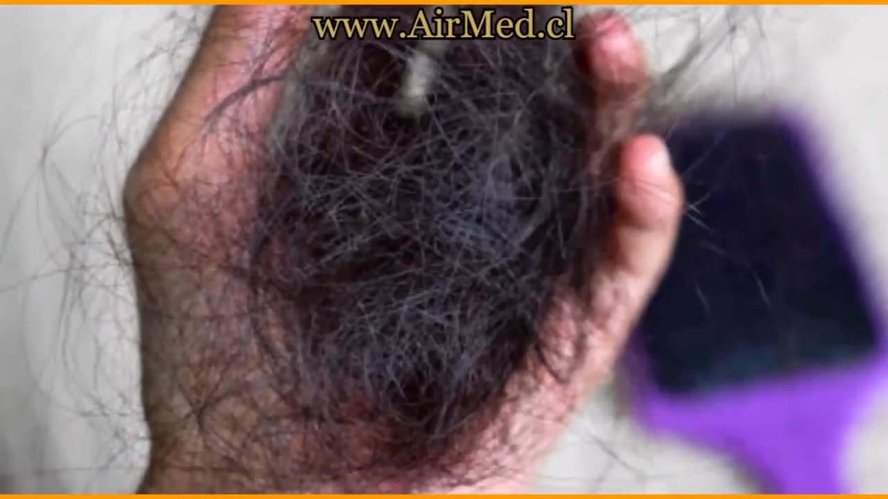 Ozempic et la perte de cheveux