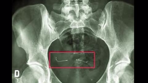 thousands of women have ESSURE