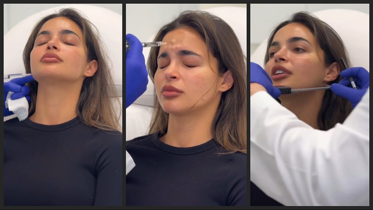 Botox Before & After with Dr. Simon Ourian | Stunning Results by Top Dermatologist!