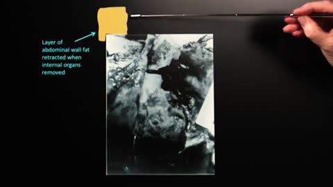 Doug Horne on Autopsy Photo Fox 8, the Mystery Photograph- w_Hofeling notes