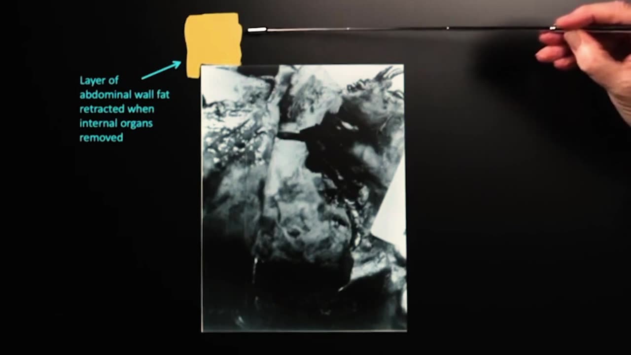 Doug Horne on Autopsy Photo Fox 8, the Mystery Photograph- w_Hofeling notes