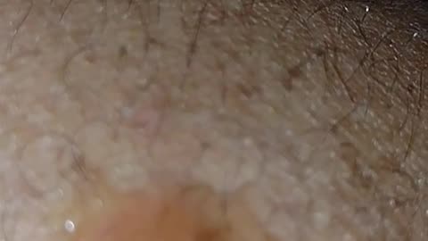 Experimenting with MMS: Kissing bug bite 1