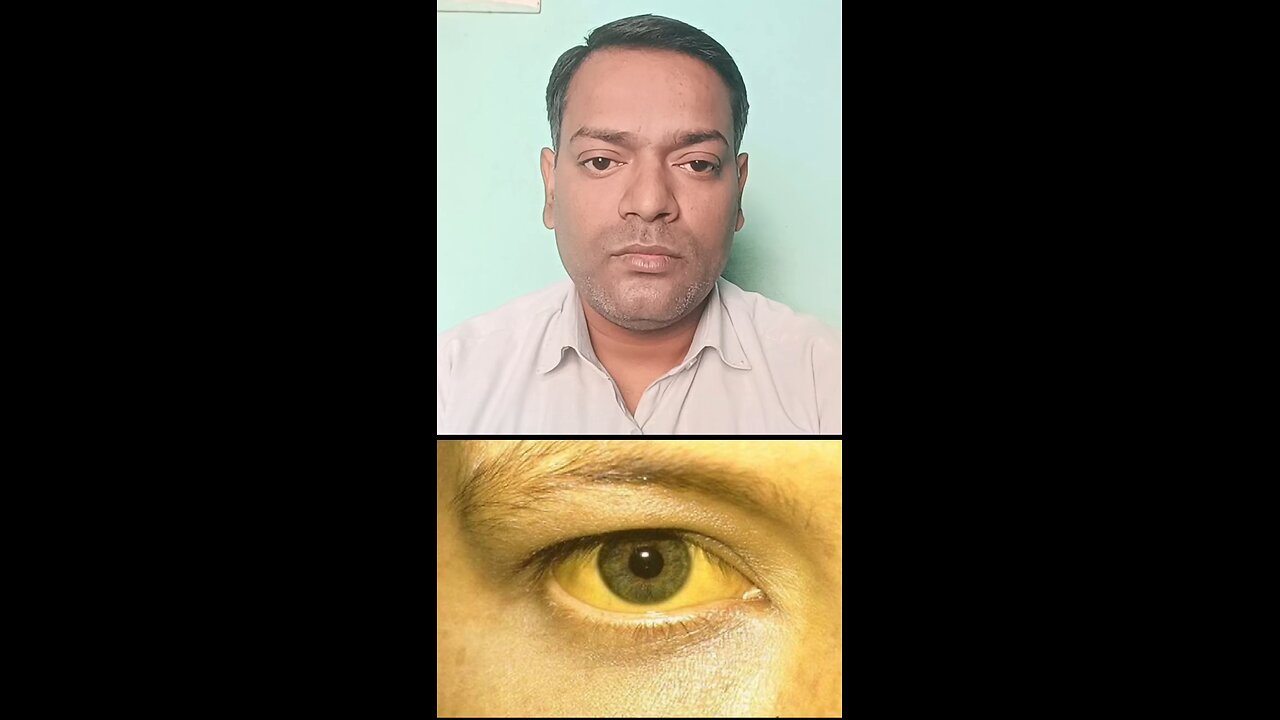 पीलिया का इलाज ।