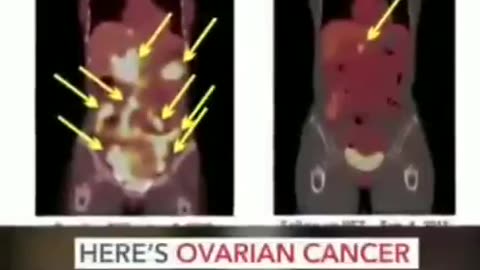 Cancer cure?