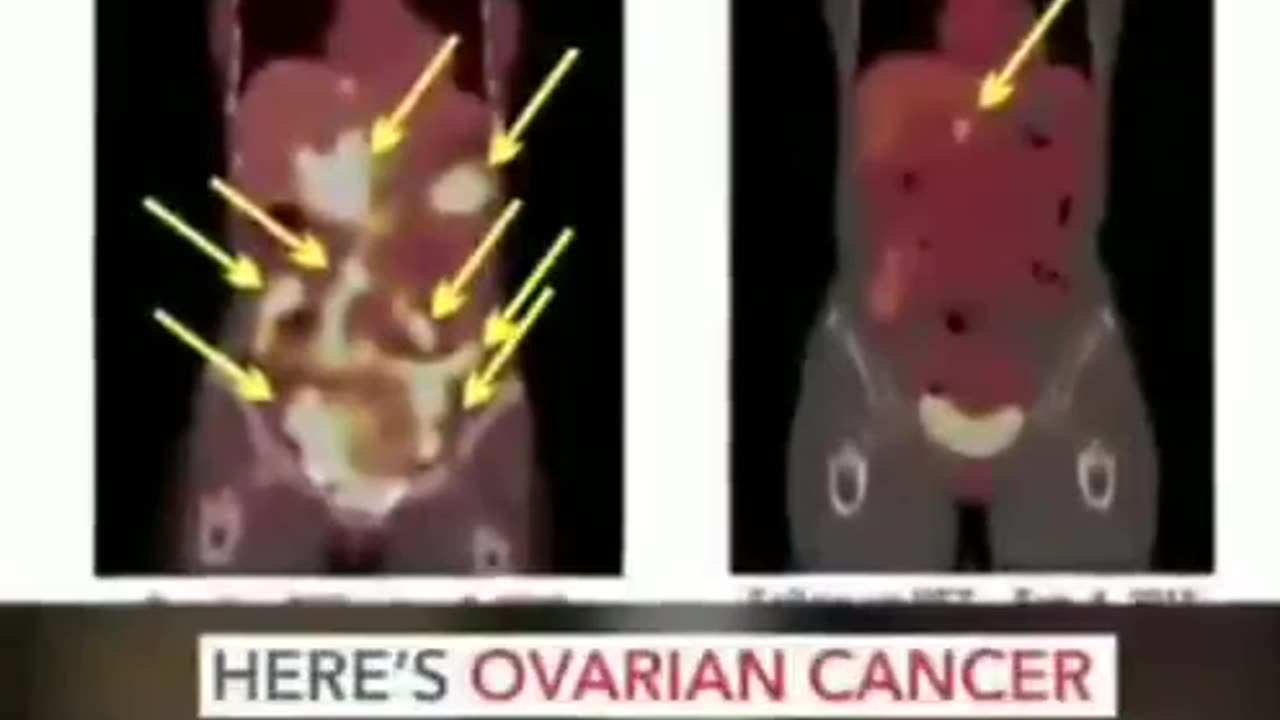 Cancer cure?
