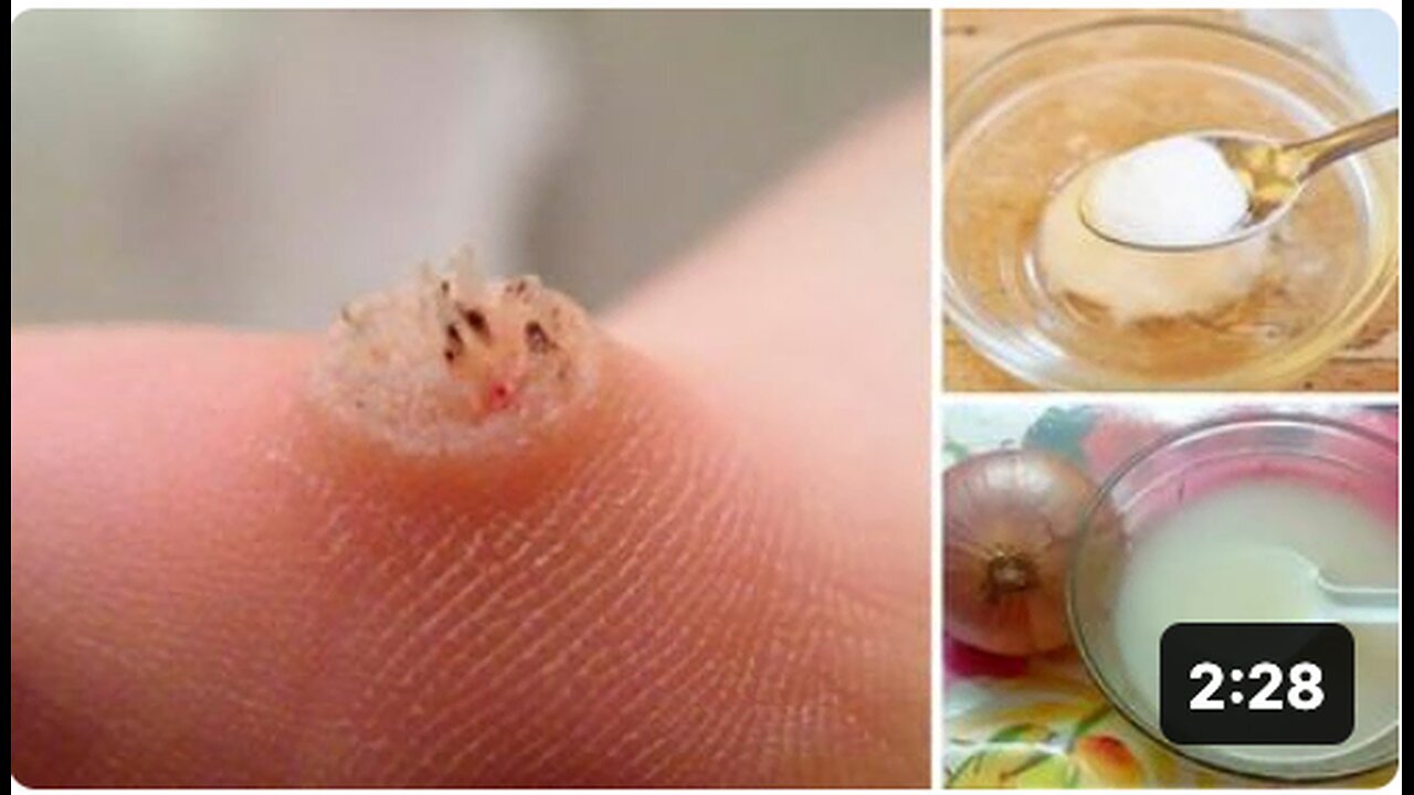 "Natural Remedies for Wart Removal"