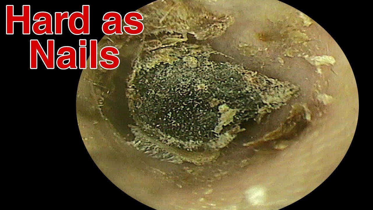 BIGGEST Ear Wax, Difficult Removal - EP6 vv