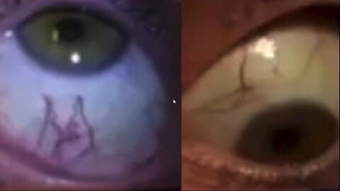 Parasites, nearly EVERYONE has them Check the👀100% of MS patients had parasites Protocol & Cleanse