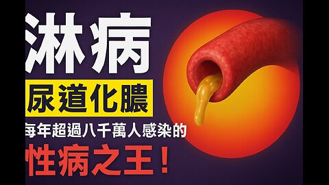 淋病：尿道化膿，每年超過八千萬人感染的「性病之王」！Gonorrhoea: Urethral Infection Affecting Over 80 Million People Each Year