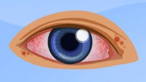 herpes bad in both eyes. please send prayers, can't see well. kinda scared I could lose some vision