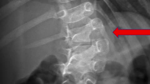 4-Year Old Congenital Scoliosis - NO SURGERY Needed!