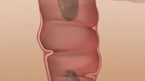 How Our Body Turns Food Into Poop